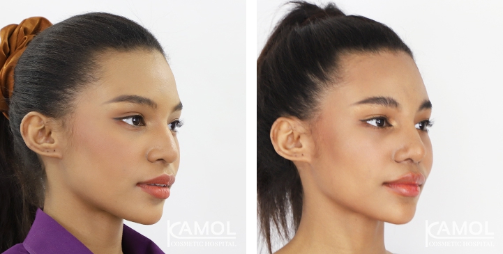 Rinoplastia 25 lg 6494958d7f216 image