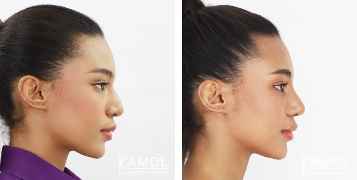 Rinoplastia 24 lg 6494958d80f26 image