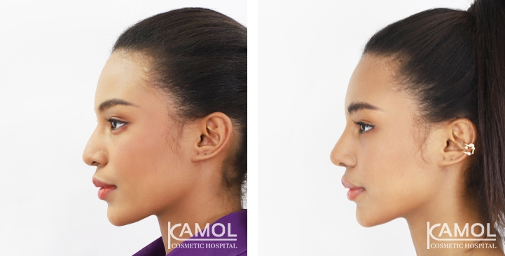 Rinoplastia 22 lg 6494958d84a59 image