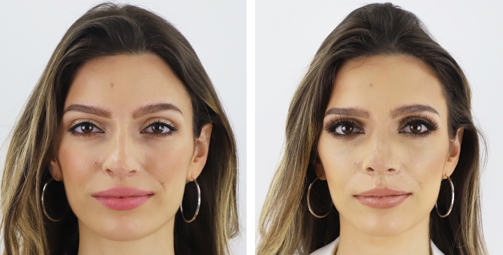 Rinoplastia 27 lg 6494958d873df image