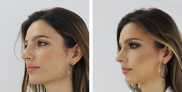 Rinoplastia 29 lg 6494958d8d06d image