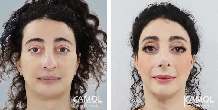Rinoplastia 35 lg 6494958d8fbff image