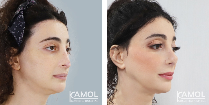 Rinoplastia 34 lg 6494958d91f92 image