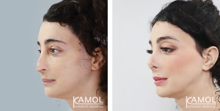 Rinoplastia 32 lg 6494958d9419b image