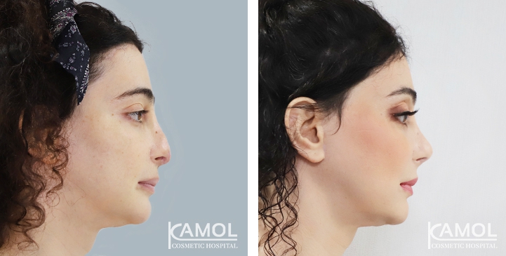 Rinoplastia 33 lg 6494958d965c8 image