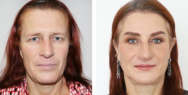 Rinoplastia 37 lg 6494958d9915a image