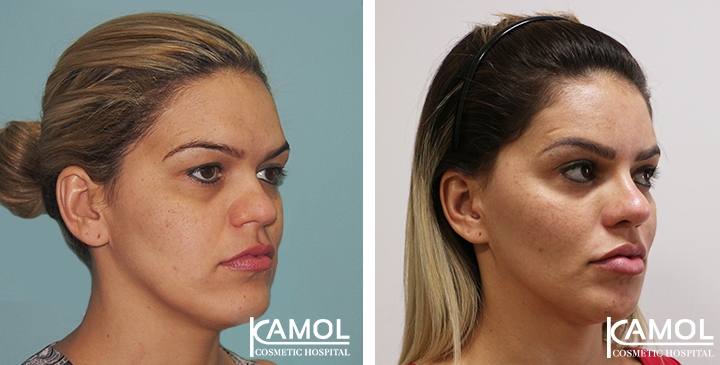 Rinoplastia 48 lg 6494958db0ce8 image