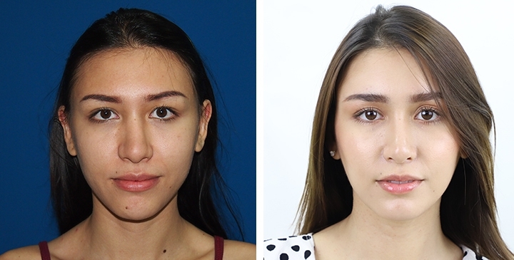 Rinoplastia 53 lg 6494958db61b4 image
