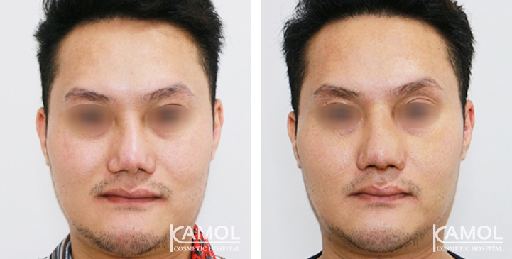 Rinoplastia 72 lg 6494958dd5ba7 image