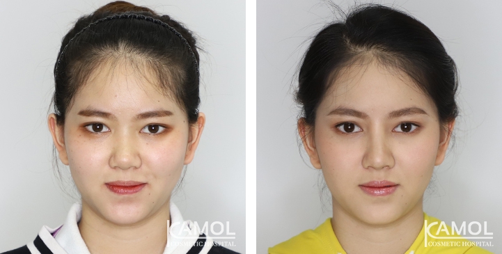 鼻のインプラント / 隆鼻術 6 lg 6494958de5be8 image