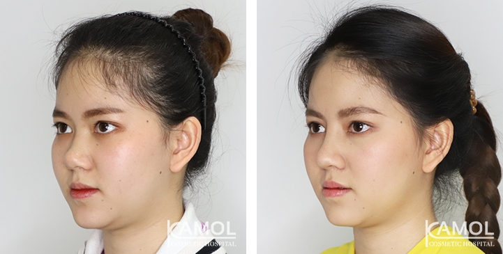 鼻のインプラント / 隆鼻術 7 lg 6494958de7f26 image