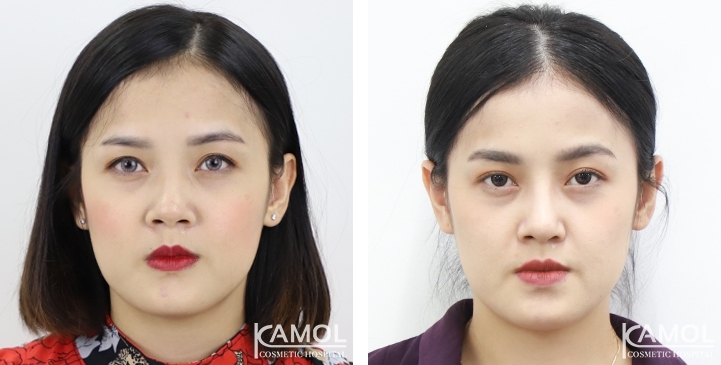 زرع الأنف / تجميل الأنف التعزيزي 8 lg 6494958df09ca image
