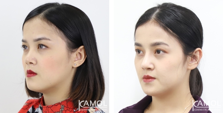 زرع الأنف / تجميل الأنف التعزيزي 12 lg 6494958df29ca image
