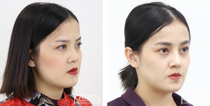 زرع الأنف / تجميل الأنف التعزيزي 9 lg 6494958e0049d image