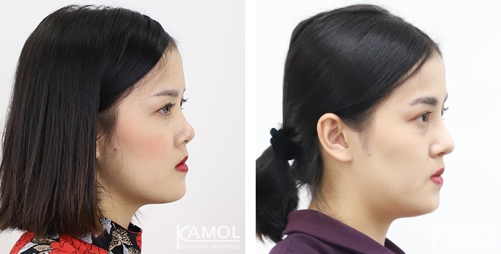 زرع الأنف / تجميل الأنف التعزيزي 11 lg 6494958e023ea image