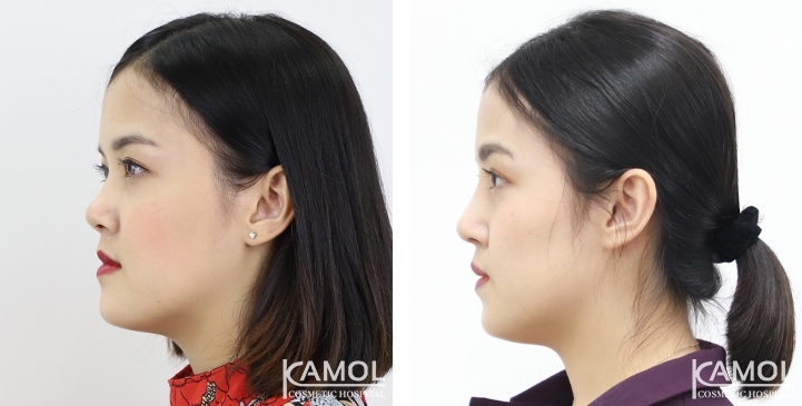 زرع الأنف / تجميل الأنف التعزيزي 10 lg 6494958e044a1 image