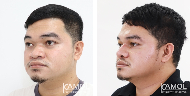 زرع الأنف / تجميل الأنف التعزيزي 28 lg 6494958e1f34b image