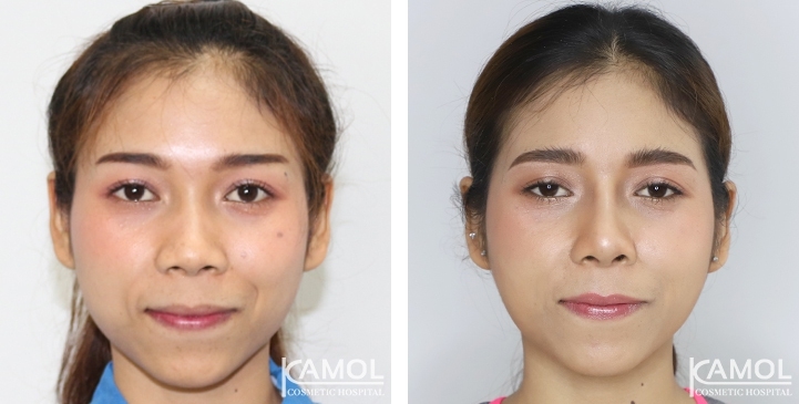 زرع الأنف / تجميل الأنف التعزيزي 32 lg 6494958e221d9 image