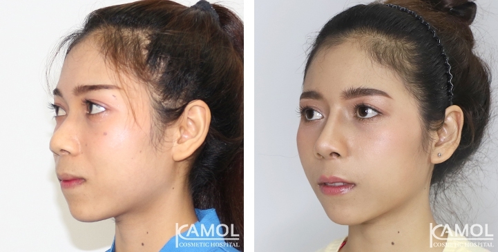 زرع الأنف / تجميل الأنف التعزيزي 35 lg 6494958e24b6b image