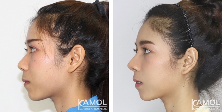 زرع الأنف / تجميل الأنف التعزيزي 34 lg 6494958e26d3a image