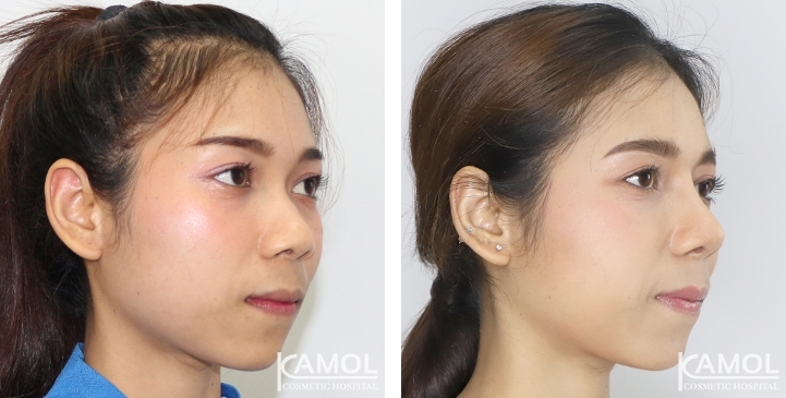زرع الأنف / تجميل الأنف التعزيزي 33 lg 6494958e28b7a image