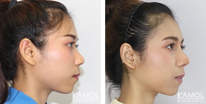 زرع الأنف / تجميل الأنف التعزيزي 36 lg 6494958e2a955 image