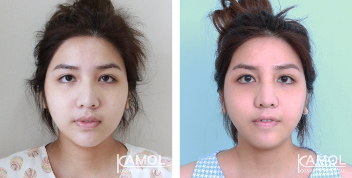 زرع الأنف / تجميل الأنف التعزيزي 38 lg 6494958e2d80d image