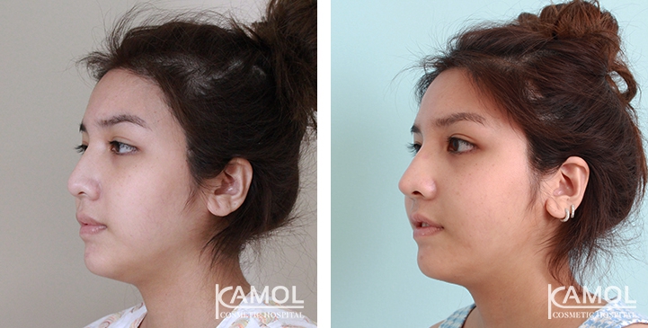 زرع الأنف / تجميل الأنف التعزيزي 42 lg 6494958e2f6e2 image