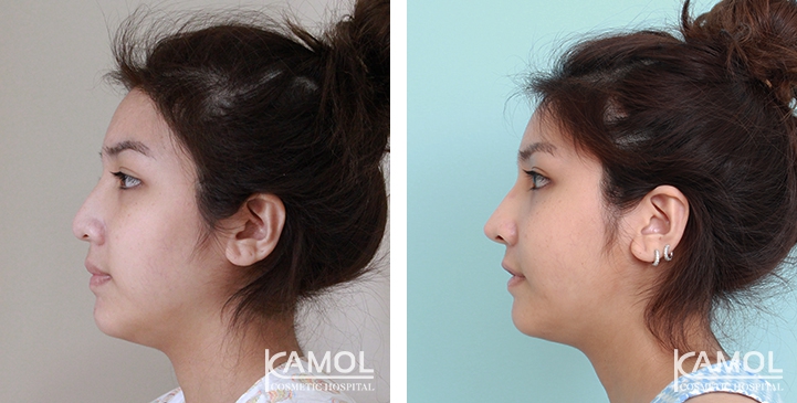 زرع الأنف / تجميل الأنف التعزيزي 40 lg 6494958e31444 image