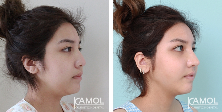 زرع الأنف / تجميل الأنف التعزيزي 39 lg 6494958e336fc image