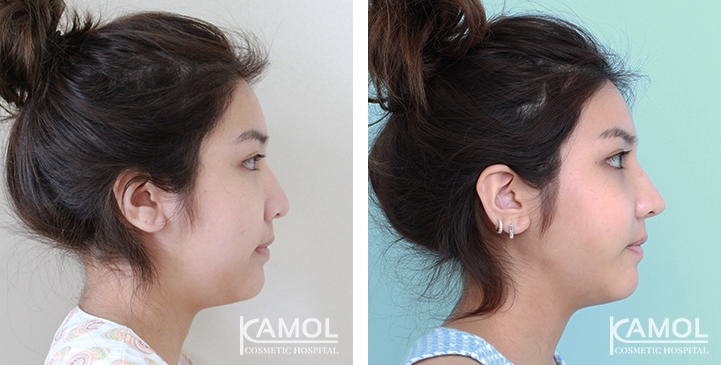 زرع الأنف / تجميل الأنف التعزيزي 41 lg 6494958e35a0a image