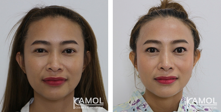 زرع الأنف / تجميل الأنف التعزيزي 44 lg 6494958e385c6 image