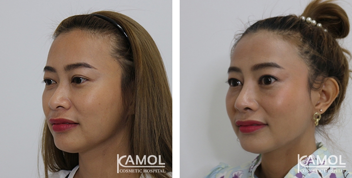 زرع الأنف / تجميل الأنف التعزيزي 48 lg 6494958e3a71b image