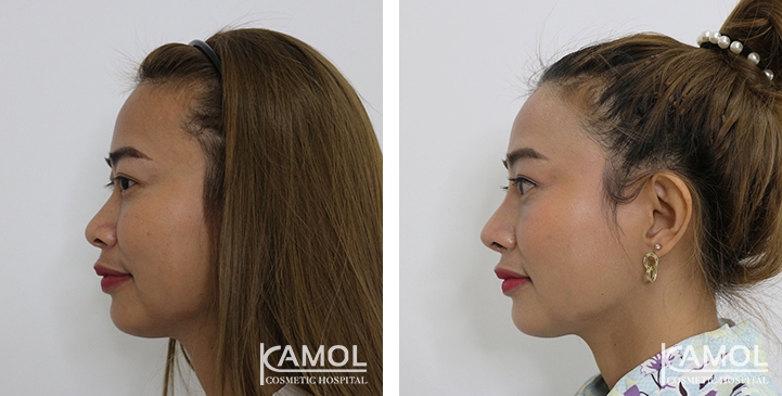 زرع الأنف / تجميل الأنف التعزيزي 47 lg 6494958e3c568 image