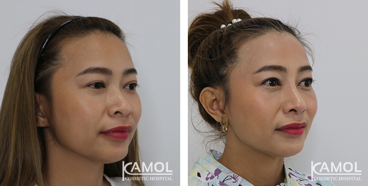 زرع الأنف / تجميل الأنف التعزيزي 46 lg 6494958e3e84f image