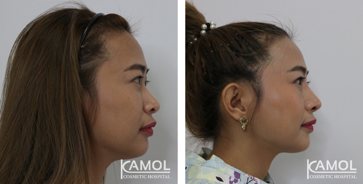 زرع الأنف / تجميل الأنف التعزيزي 45 lg 6494958e40abc image