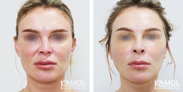 زرع الأنف / تجميل الأنف التعزيزي 50 lg 6494958e437a1 image