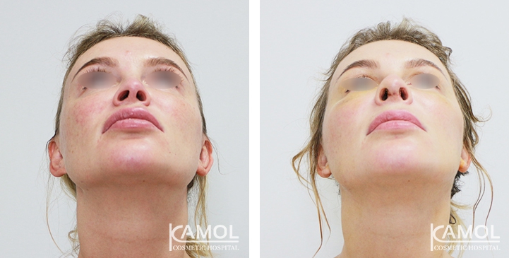 زرع الأنف / تجميل الأنف التعزيزي 51 lg 6494958e458ab image