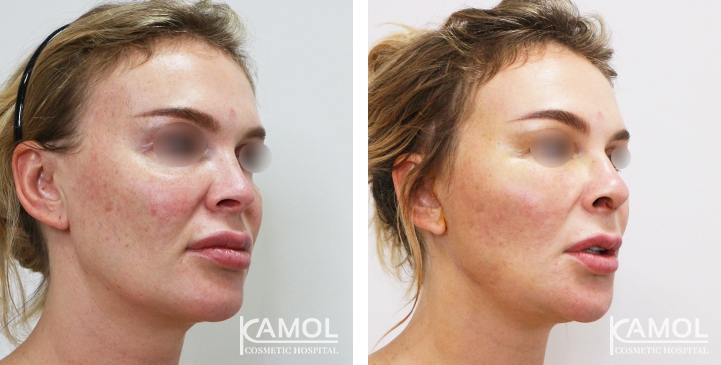 زرع الأنف / تجميل الأنف التعزيزي 53 lg 6494958e47a9a image