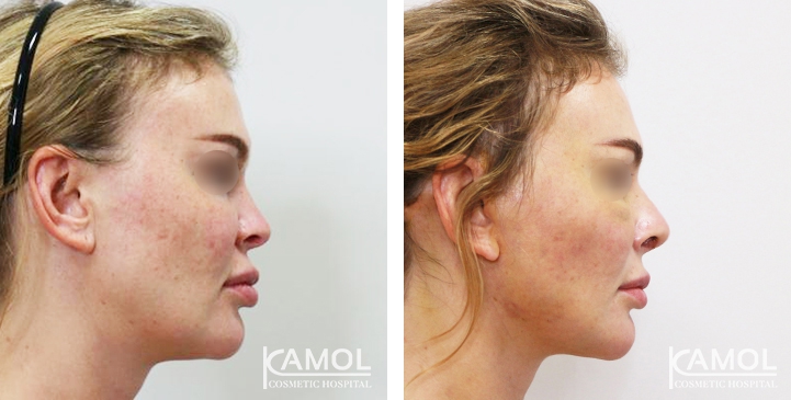 زرع الأنف / تجميل الأنف التعزيزي 52 lg 6494958e49d98 image