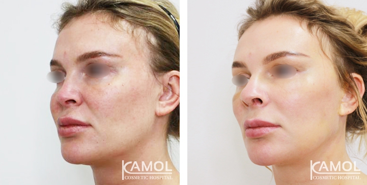زرع الأنف / تجميل الأنف التعزيزي 55 lg 6494958e4bd91 image