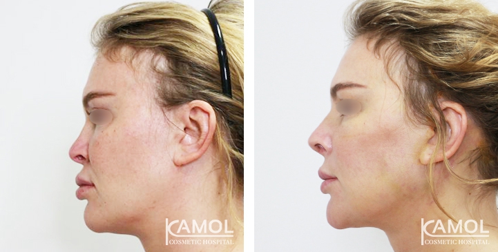 زرع الأنف / تجميل الأنف التعزيزي 54 lg 6494958e4dbf6 image