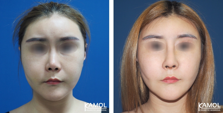 زرع الأنف / تجميل الأنف التعزيزي 57 lg 6494958e5082c image