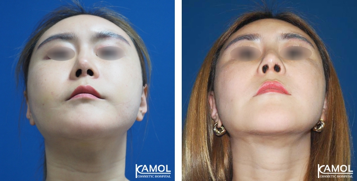 زرع الأنف / تجميل الأنف التعزيزي 58 lg 6494958e529b3 image