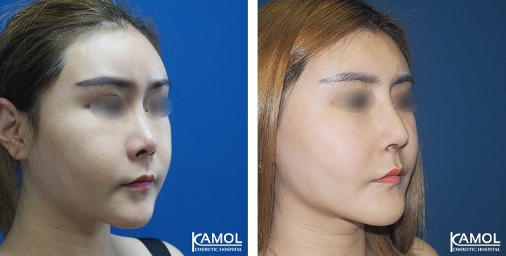 زرع الأنف / تجميل الأنف التعزيزي 61 lg 6494958e54c1b image