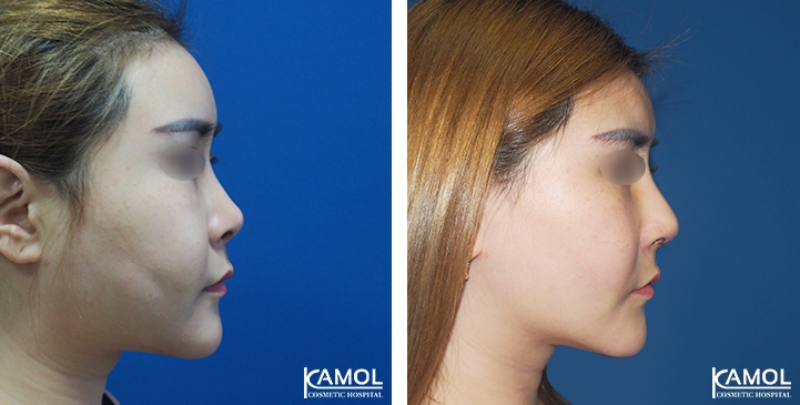 زرع الأنف / تجميل الأنف التعزيزي 60 lg 6494958e56d88 image