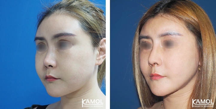 زرع الأنف / تجميل الأنف التعزيزي 59 lg 6494958e58dee image