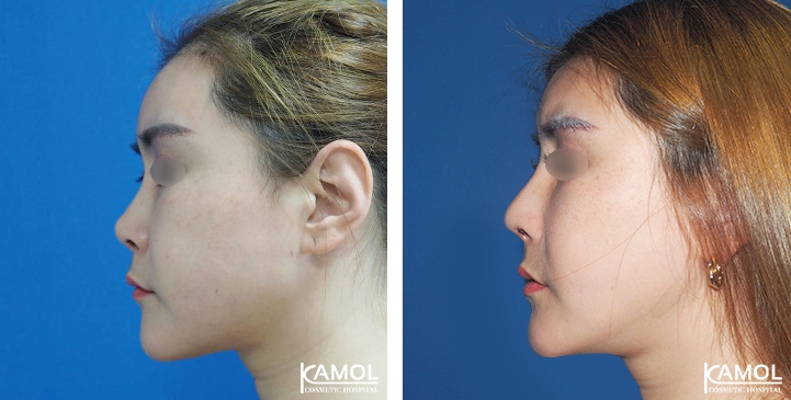 زرع الأنف / تجميل الأنف التعزيزي 62 lg 6494958e5af08 image