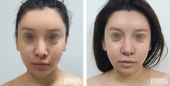 زرع الأنف / تجميل الأنف التعزيزي 64 lg 6494958e5dada image