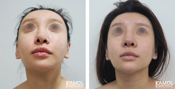 زرع الأنف / تجميل الأنف التعزيزي 69 lg 6494958e5f9f9 image